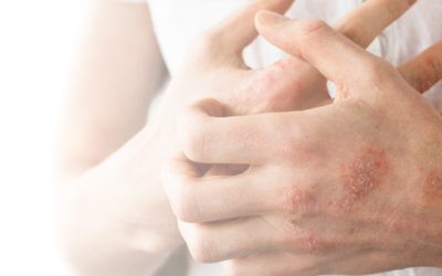 Fighting eczema? Here are 4 products that help